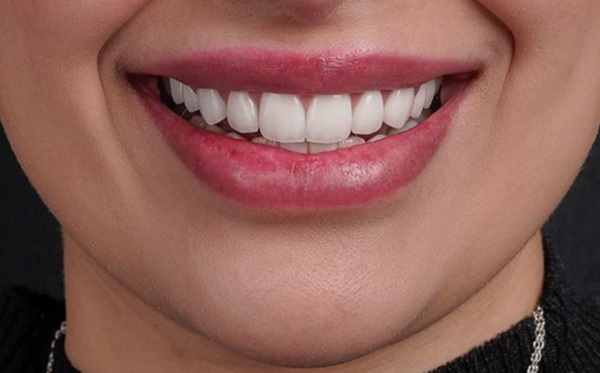 How A Smile Makeover Brings Balance To Your Entire Smile