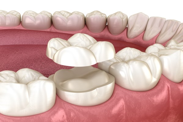 How Dental Crowns Can Give You A New Smile